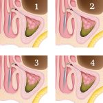 In-Office Balloon Sinuplasty