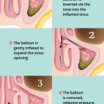 In-Office Balloon Sinuplasty Procedure