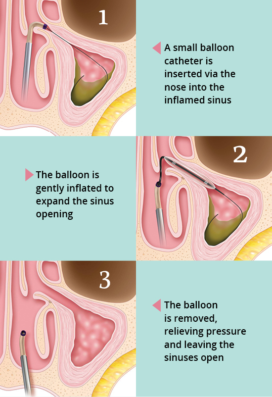 In-Office Balloon Sinuplasty Procedure